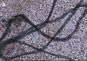 Blue fiber in Alzheimer's disease sample