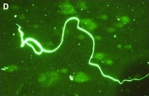 Blue fiber in Alzheimer's disease sample
