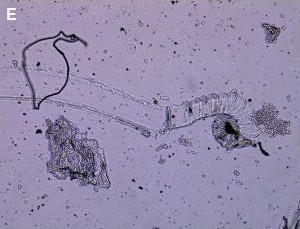 Blue fiber in Alzheimer's disease sample